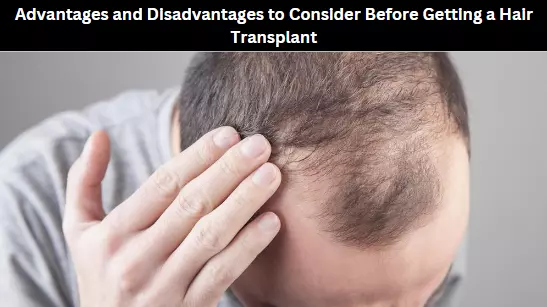 Advantages and Disadvantages to Consider Before Getting a Hair Transplant