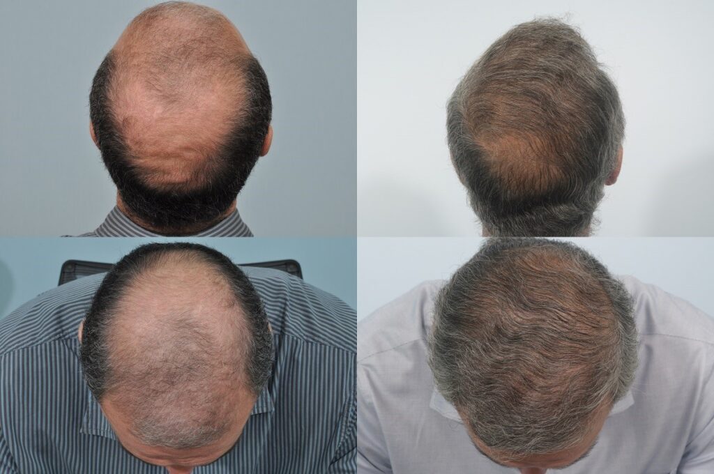 Advantages and Disadvantages to Consider Before Getting a Hair Transplant