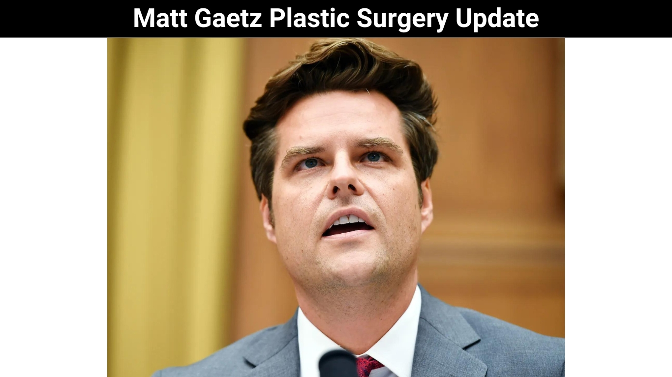 Matt Gaetz Plastic Surgery Update