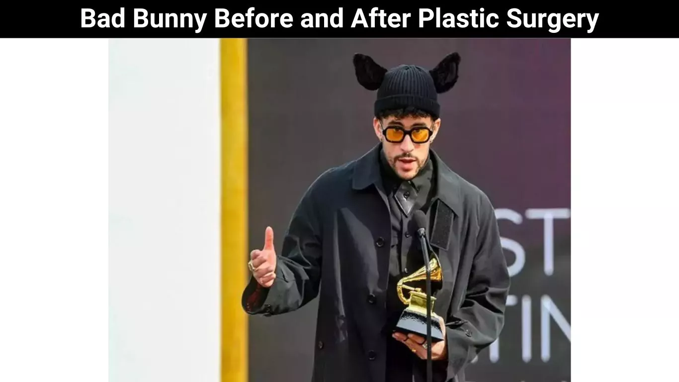 Bad Bunny Before and After Plastic Surgery